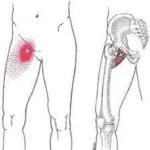 an area of groin pain is indicated in the top of the right leg