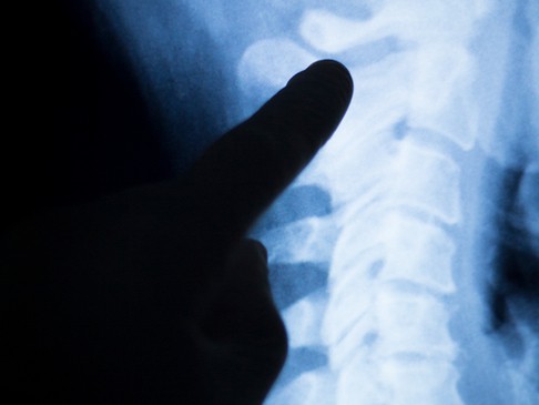 A finger points to the cervical spine on an x-ray