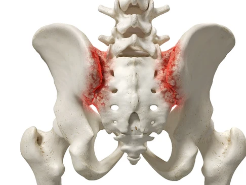 digital pelvis showing locations of SI joints, depicted in red to imply inflammation