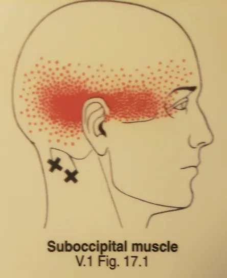 side view of human head and neck showing location of suboccipital muscles