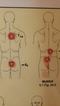 locations of trigger points along the spine